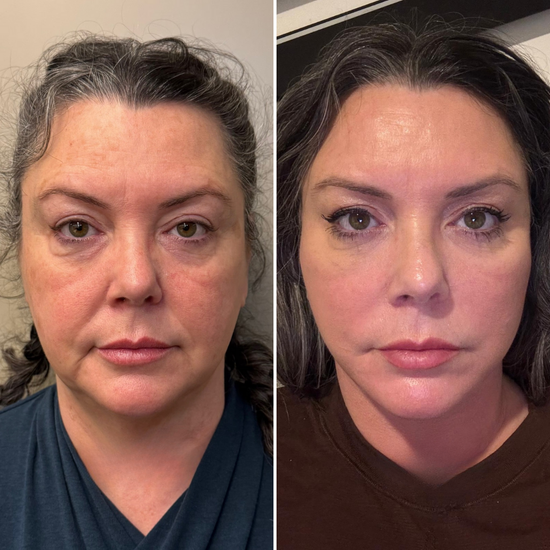 Antes y después del cepillo linfático facial — ojeras y cara cansada